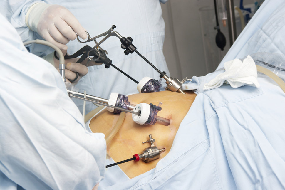 Does A Gastric Bypass Cures Diabetes?
